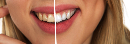 Seeking Safe and Stable At-Home Teeth Whitening Technologies with Low or Zero Peroxide Release